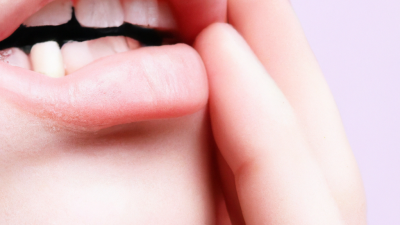 Solusi Efektif Mengatasi Sakit Gigi dengan Cara Ampuh